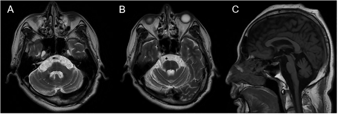 A case report of spinocerebellar ataxia with TRPC3 gene mutation and ...