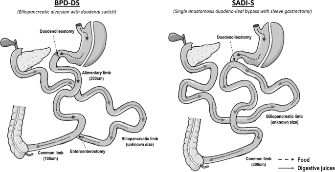 bypass to javascript how login Biliopancreatic (BPD duodenal DS switch with diversion