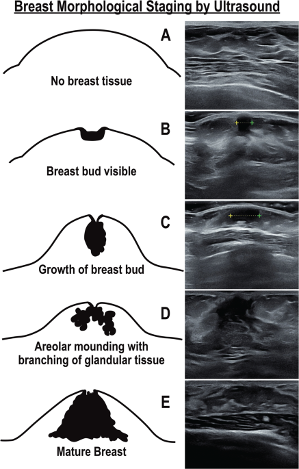 The breasts are two glandular organs rich in adipose tissue that