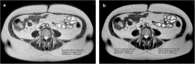 A new approach to quantify visceral fat via bioelectrical impedance analysis and ultrasound compared to mri