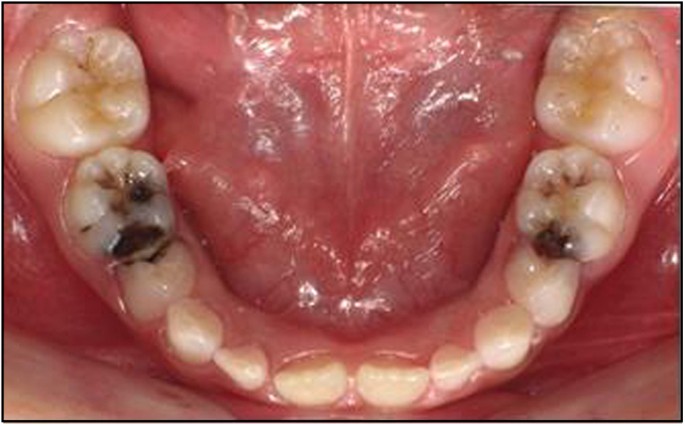 Common dental diseases in children and malocclusion | International Journal  of Oral Science