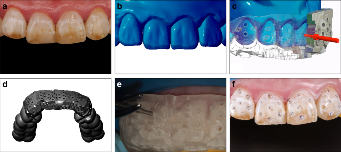 Minimal invasive microscopic tooth preparation in esthetic