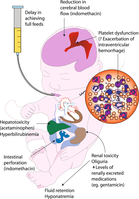 PDF] Patent Ductus Arteriousus Device Closure in an Infant with Rubinstein–Taybi  Syndrome