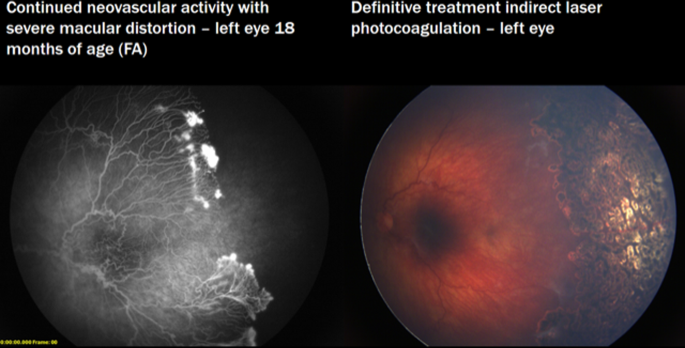 80 Years of vision: preventing blindness from retinopathy of prematurity |  Journal of Perinatology