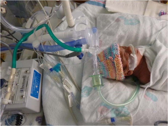 Nasal high-frequency jet ventilation (NHFJV) as a novel means of  respiratory support in extremely low birth weight infants | Journal of  Perinatology