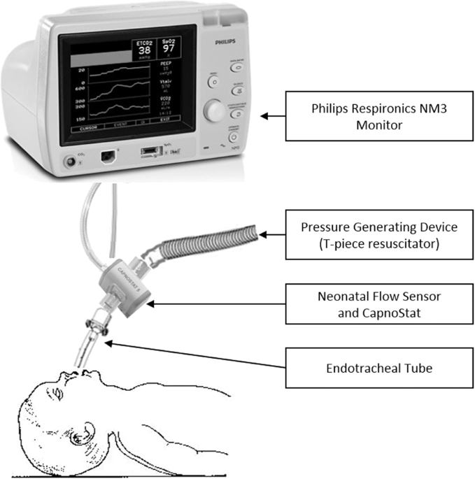 Tidal volume measurements in the delivery room in preterm infants 