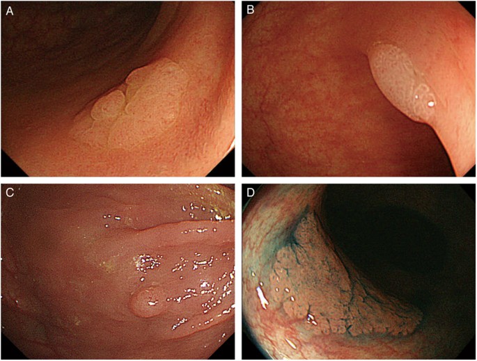 Superficially serrated adenoma: a proposal for a novel subtype of colorectal serrated lesion