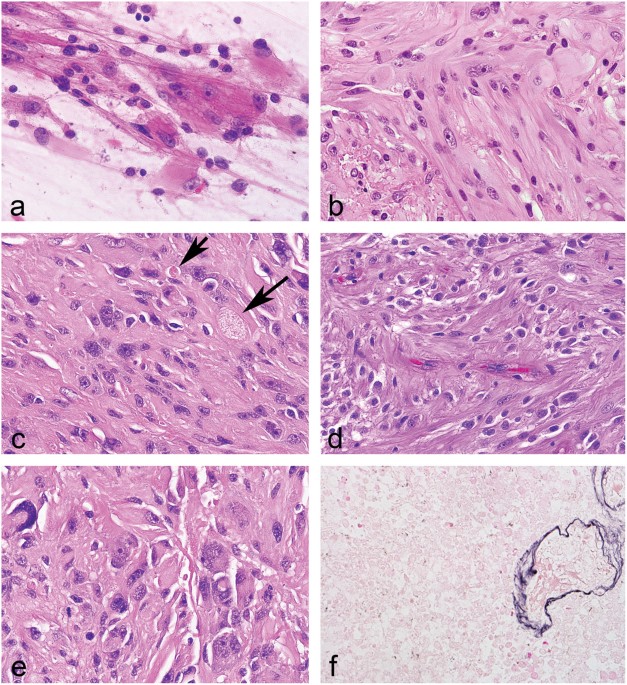 subependymal giant cell astrocytoma like astrocytoma a neoplasm