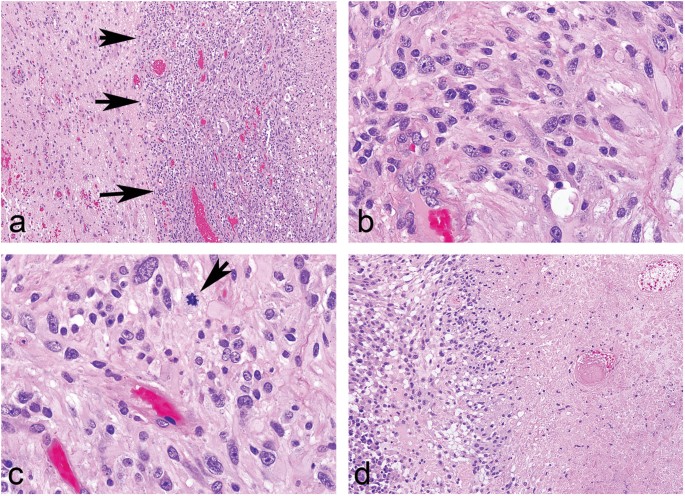subependymal giant cell astrocytoma like astrocytoma a neoplasm