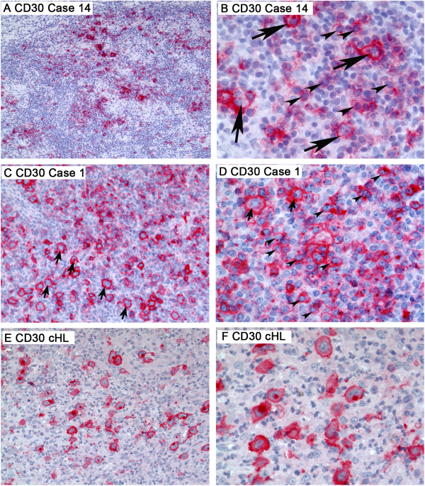 CD30 expression in neoplastic T cells of follicular T cell lymphoma is a  helpful diagnostic tool in the differential diagnosis of Hodgkin lymphoma |  Modern Pathology