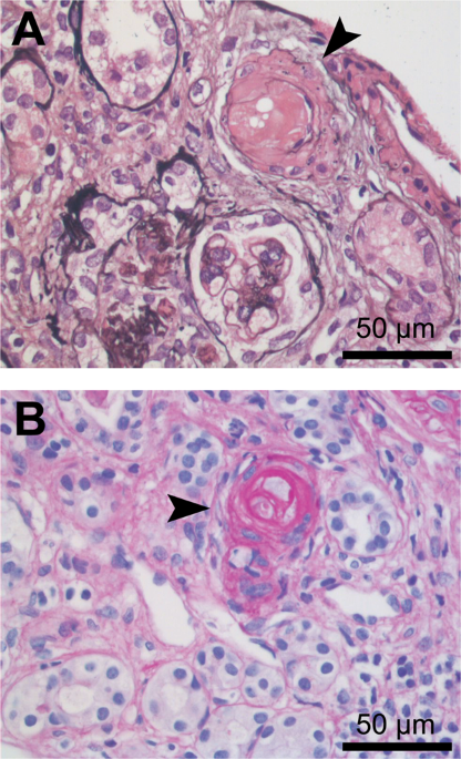 Complement Mediated Microangiopathy In Iga Nephropathy And Iga Vasculitis With Nephritis Modern Pathology Complement Mediated Microangiopathy In Iga Nephropathy And Iga Vasculitis With Nephritis Modern Pathology