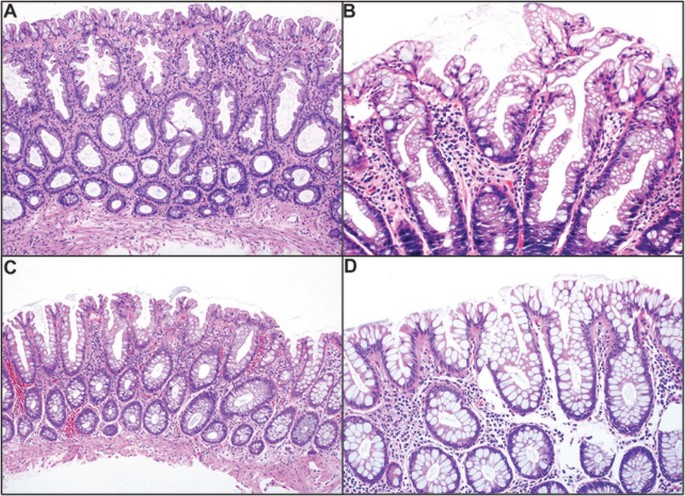 An Update On The Morphology And Molecular Pathology Of Serrated Colorectal Polyps And Associated Carcinomas Modern Pathology