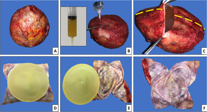 A proposal for pathologic processing of breast implant capsules in patients  with suspected breast implant anaplastic large cell lymphoma | Modern  Pathology