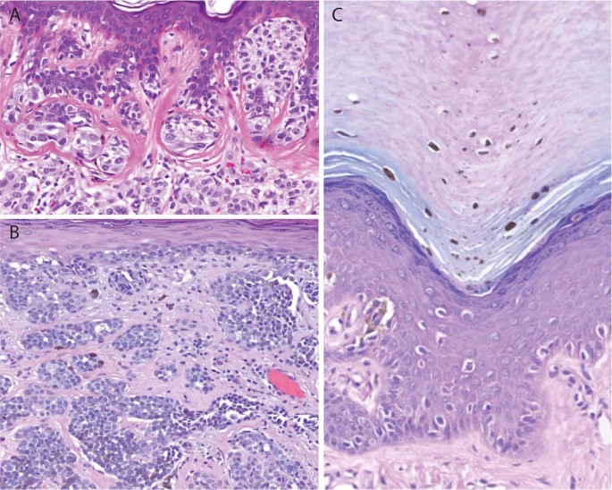 melanotic macule vs nevus New and evolving concepts of melanocytic nevi and melanocytomas