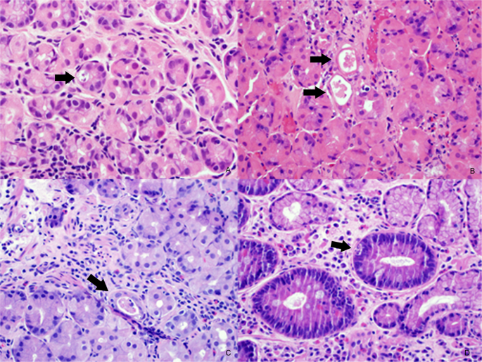 Evaluation of the lower histologic threshold for gastric graft versus
