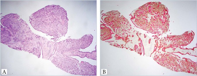 papilloma virus biopsia negativa dysbiosis gut microbiota
