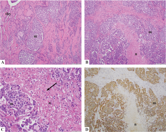 Grading of medullary thyroid carcinoma on the basis of tumor necrosis and  high mitotic rate is an independent predictor of poor outcome | Modern  Pathology
