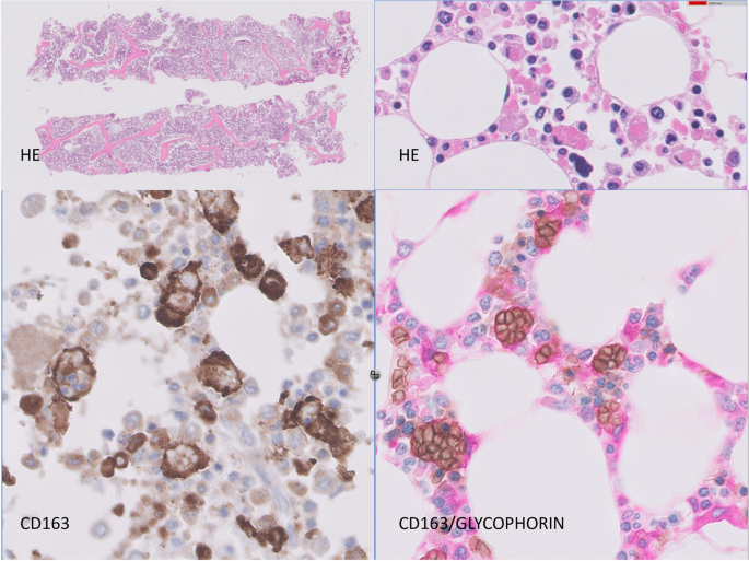 Histiocytic Hyperplasia With Hemophagocytosis And Acute Alveolar Damage In Covid 19 Infection Modern Pathology