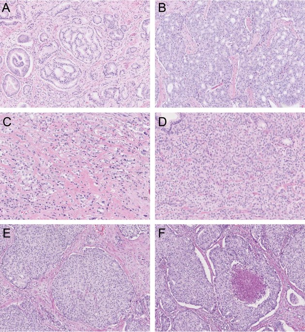 gleason 5 prostate cancer prosztata megnagyobbodás gyógyszer vény nélkül