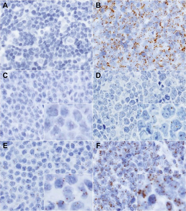 A new diagnostic algorithm using biopsy specimens in adult T-cell leukemia/lymphoma: combination of RNA in situ hybridization and quantitative PCR for HTLV-1