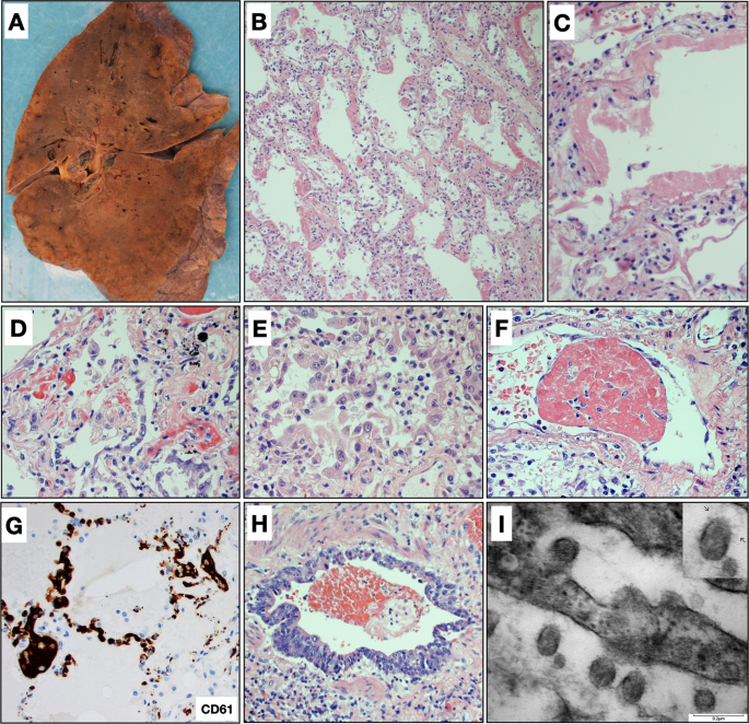 Pathophysiology of SARS-CoV-2: the Mount Sinai COVID-19 autopsy experience  | Modern Pathology
