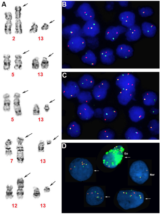 Myeloid/lymphoid neoplasms with FLT3 rearrangement | Modern Pathology