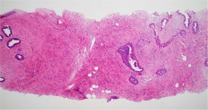 Myofibroblastic stromal hyperplasia of the breast | Modern Pathology