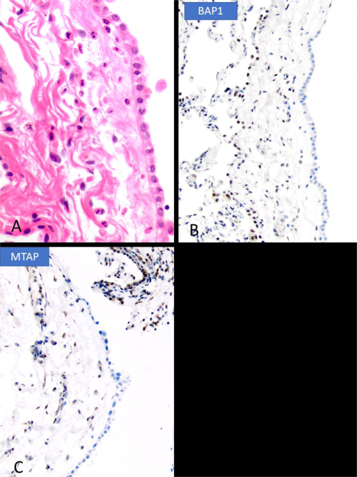 Pleural mesothelioma classification—update and challenges