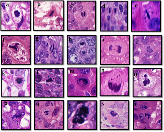 Cancer Cell Squamous: Power up your knowledge on Squamous Cell Carcinoma