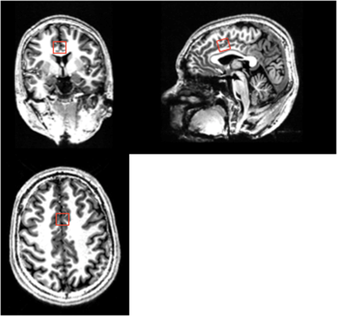 Early Treatment Response In First Episode Psychosis A 7 T Magnetic Resonance Spectroscopic Study Of Glutathione And Glutamate Molecular Psychiatry