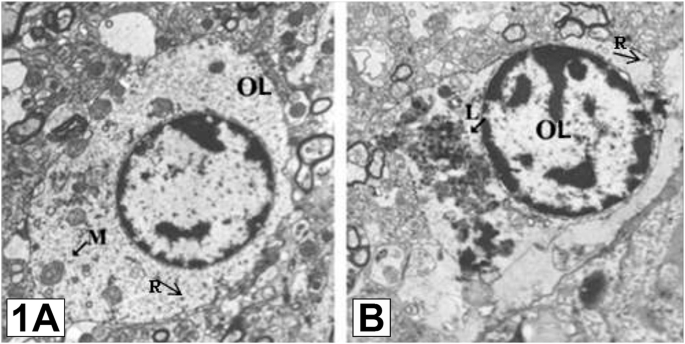 glutathione dosage for ms Glutathione in Skin Aging and Tissue Regeneration: A Systematic Review of  Molecular Mechanisms, Redox Modulation, and Biomedical Implications