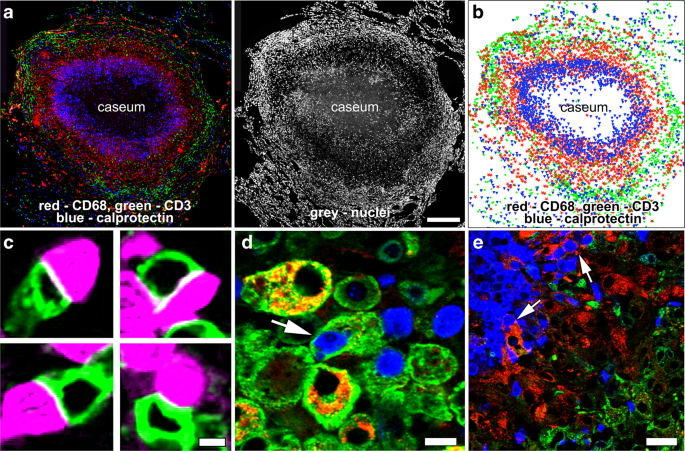 Neutrophils Express Pro And Anti Inflammatory Cytokines In Granulomas From Mycobacterium Tuberculosis Infected Cynomolgus Macaques Mucosal Immunology