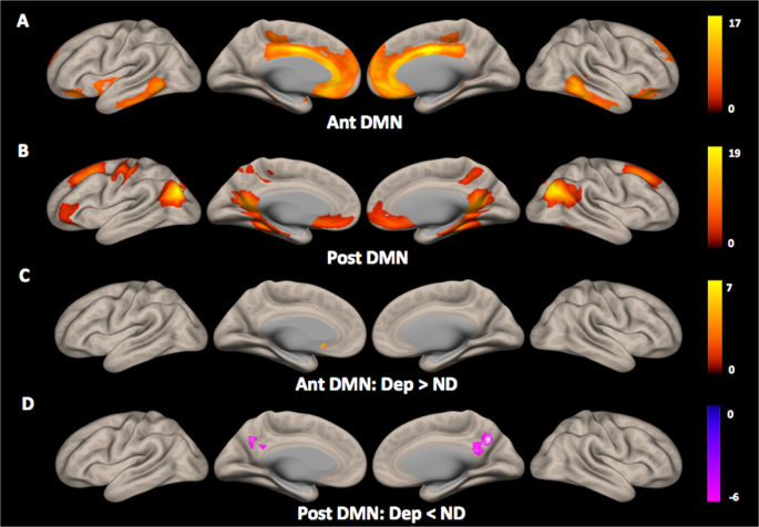 Default mode network dissociation linking cerebral beta amyloid retention  and depression in cognitively normal older adults | Neuropsychopharmacology