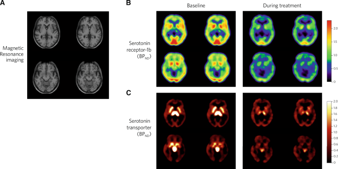 Trajectories of late-life depression: insights from molecular imaging |  Neuropsychopharmacology