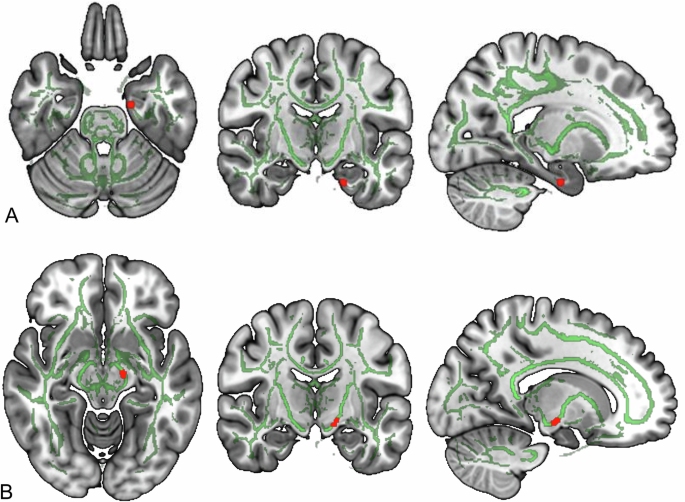 medizinische vibration Good vibrations: Sternal vibration enhances white matter density and  interoceptive awareness