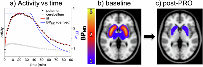 Robust changes in brain function require high D2 receptor occupancy by prochlorperazine: an imaging correlate for the antipsychotic therapeutic window