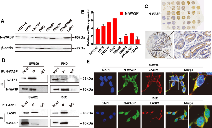 Lasp1 interacts with n-wasp to activate the arp2/3 complex and facilitate colorectal cancer metastasis by increasing tumour budding and worsening the pattern of invasion