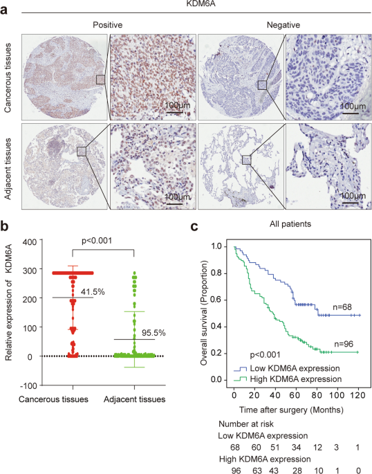 Histone 3 lysine-27 demethylase kdm6a coordinates with kmt2b to play an oncogenic role in nsclc by regulating h3k4me3