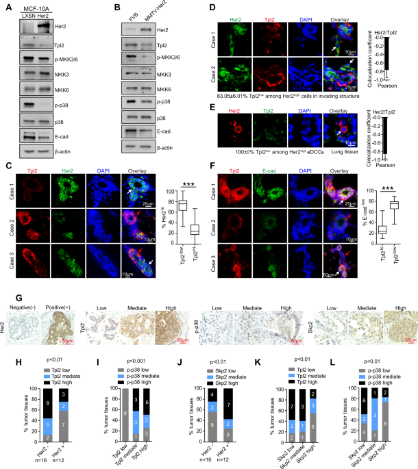 Her2 promotes early dissemination of breast cancer by suppressing the p38 pathway through skp2-mediated proteasomal degradation of tpl2