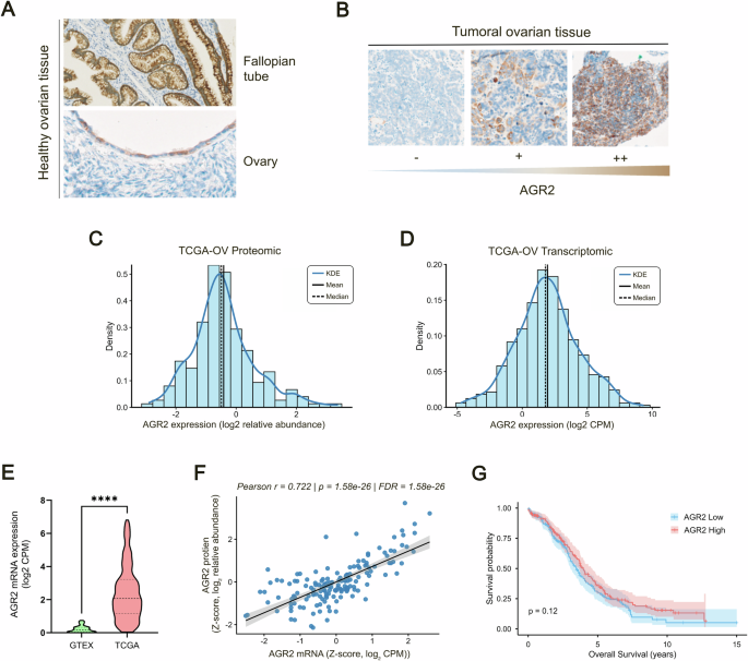 Complementary intra- and extracellular AGR2 activities support epithelial ovarian cancer cell aggressiveness