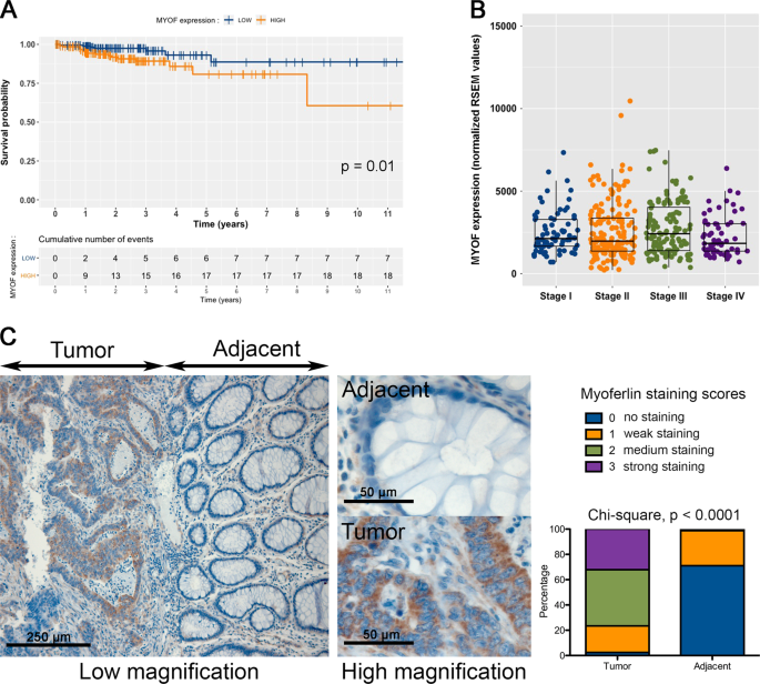 Human Colon Cancer Cells Highly Express Myoferlin To Maintain A Fit Mitochondrial Network And Escape P53 Driven Apoptosis Oncogenesis