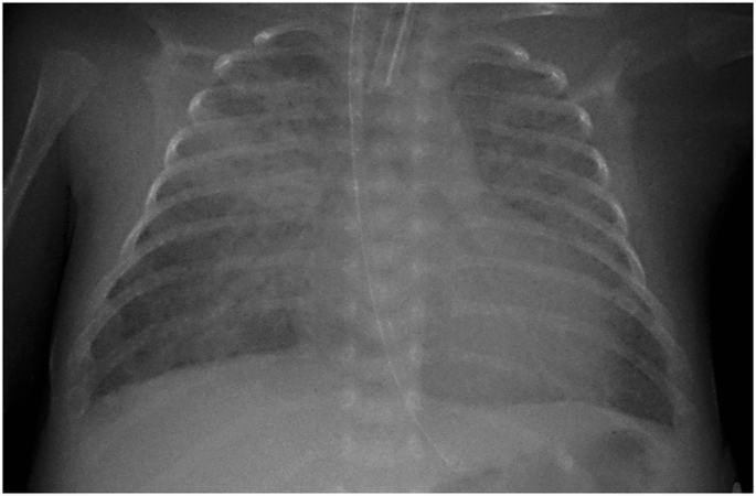 Application Of Neonatologist Performed Echocardiography In The Assessment Of A Patent Ductus Arteriosus Pediatric Research