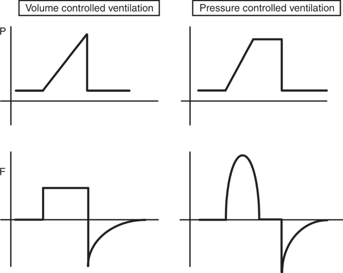 Modes and strategies for providing conventional mechanical ventilation in  neonates | Pediatric Research