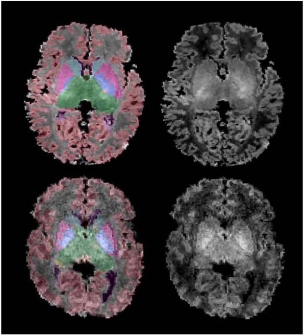 Subcortical brain volumes in neonatal hypoxic–ischemic encephalopathy
