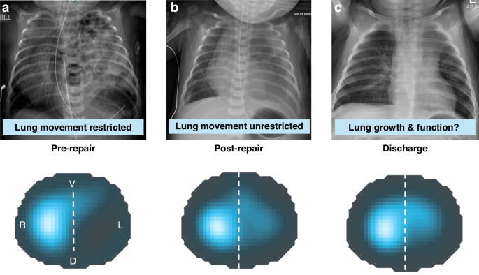 Regional lung function in congenital diaphragmatic hernia assessed using electrical impedance tomography