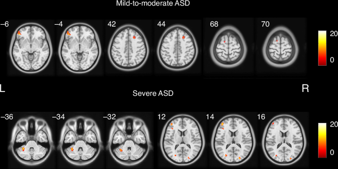 Associations between vitamin D and brain volume in children with autism ...