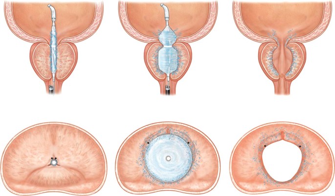 Prostate Hyperplasia 1 Art Adja meg a prosztatitot