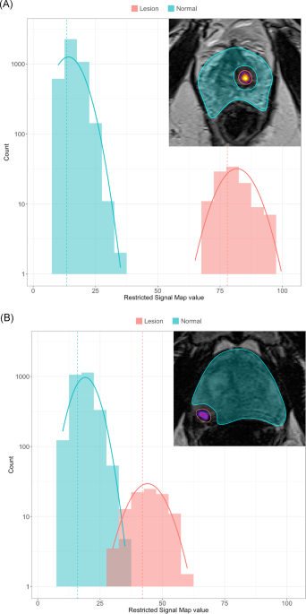 Prospective comparison of restriction spectrum imaging and non-invasive biomarkers to predict upgrading on active surveillance prostate biopsy