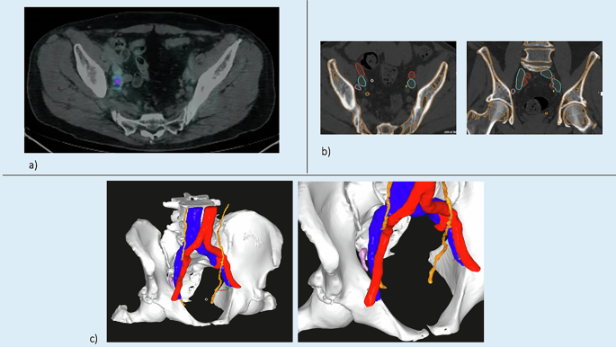 Augmented Reality PSMA-3D guided robotic pelvic lymph node dissection ...