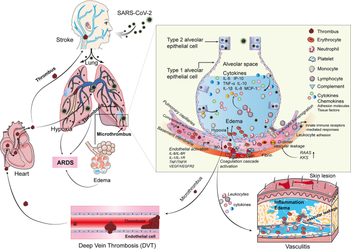 Endothelial cell infection and endotheliitis in COVID-19 - The Lancet